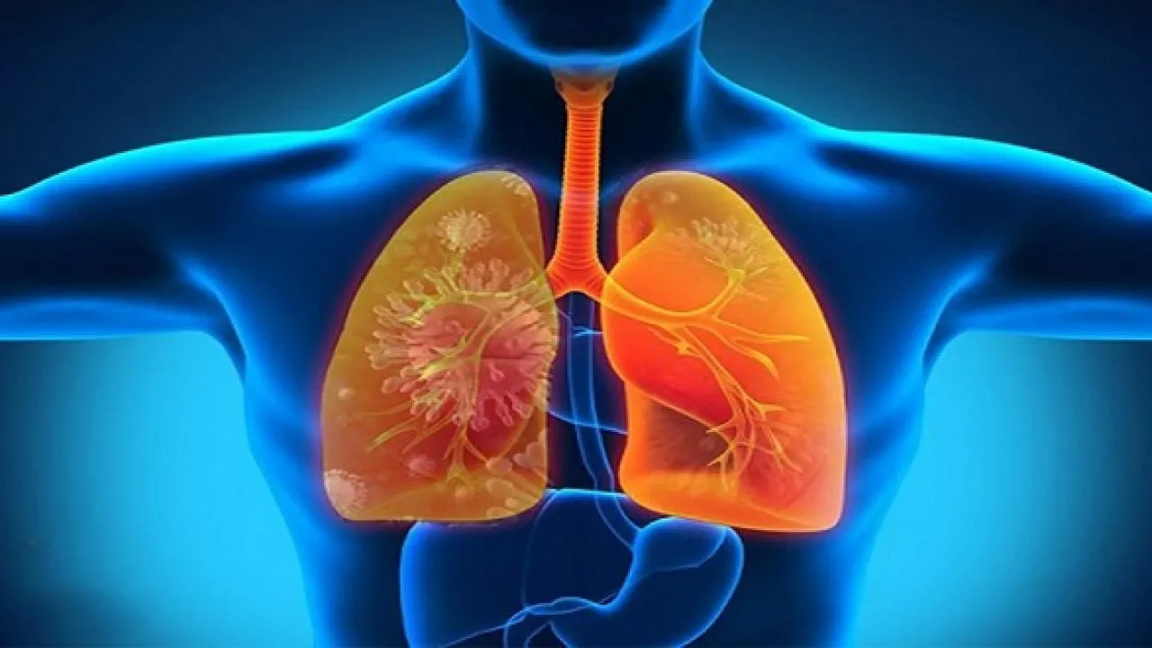 Cảnh báo 5 triệu chứng viêm phổi thường gặp mà bạn cần biết!